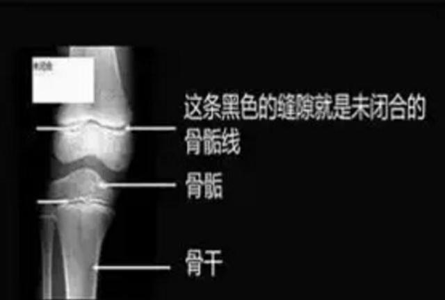 这3个坏习惯，会让孩子骨骺线提前闭合组长不高，家长要注意