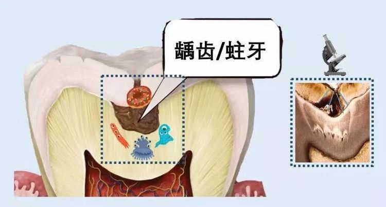 一口好牙太重要了！牙齿上面的那些沟沟，到底要不要封？