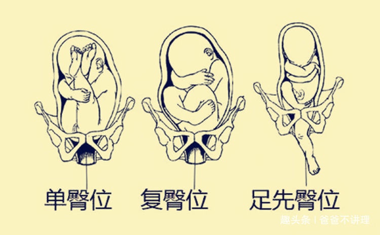 哪一种分娩方式更安全？能顺则顺，顺不了不要勉强
