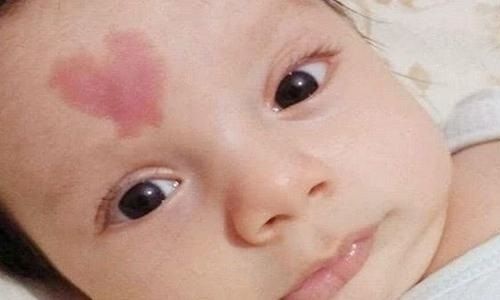 孕期的3个行为，容易让胎记找上宝宝，不想被孩子埋怨忍着点吧