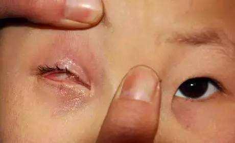 男童玩干燥剂把眼炸伤：干燥剂入眼、误食的急救措施，当妈的必学