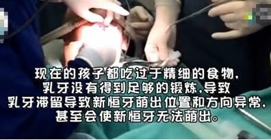 孩子六岁多，牙齿上出现了“双排牙”，急坏妈妈最后还得拔