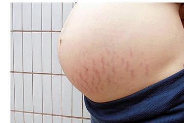 孕妇肚子痒是要长妊娠纹吗
