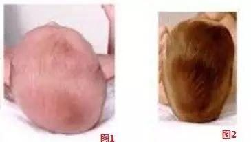 还在给宝宝睡头型？小心睡成头颅畸形，后悔终生