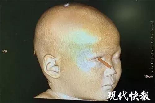 揪心！筷子戳进2岁女童眼睛，深入头颅…医生：又是这个习惯惹的祸