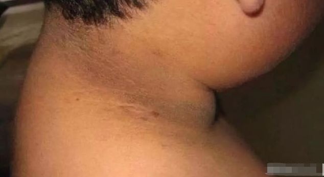 家长赶紧看看！孩子“黑脖子”洗不白，不是脏，而是患了一种病！