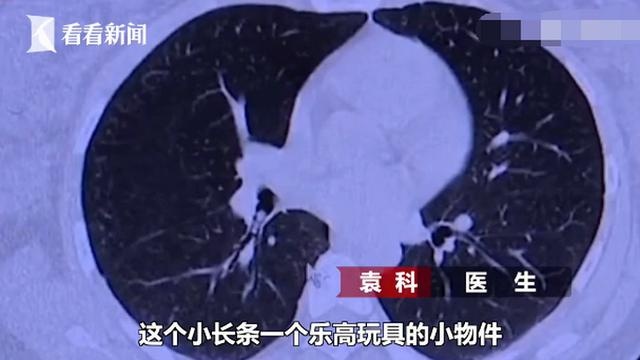 什么操作？1岁女孩误吞一块乐高积木，最后被送去急救的竟是妈妈