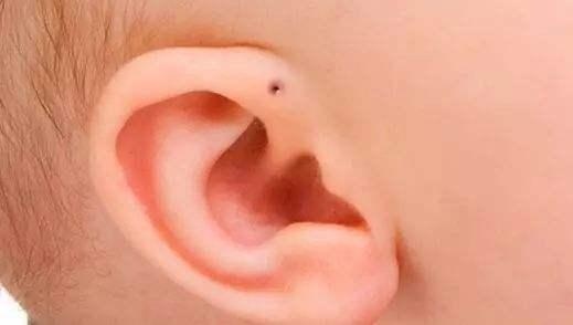 宝宝耳朵上有''富贵孔''，别忙着高兴，稍不注意就成大问题