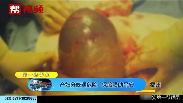 急！福州28周胎儿分娩危险！保大人还是保小孩？医生竟然这么做......