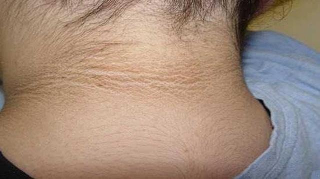 家长赶紧看看！孩子“黑脖子”洗不白，不是脏，而是患了一种病！