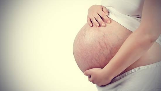 孕期妊娠纹也挑人，3类孕妈躲得开，能符合其中一条，也让人羡慕