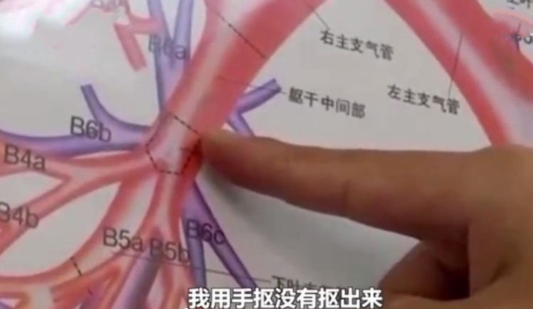 母亲为女儿“人工呼吸”吸异物，不料吸进自己气管，险窒息被送医