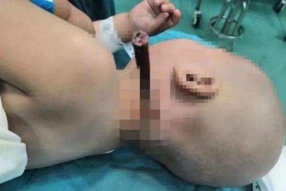 可怕！铅笔插进孩子后脑勺险没命！务必让孩子远离这些尖锐物