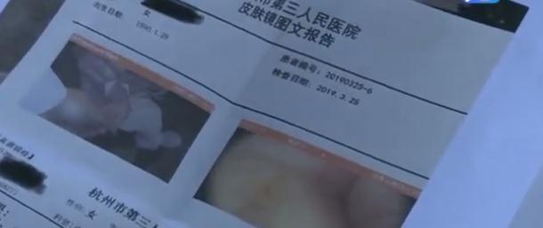 两月宝宝身上长出40多颗疥疮，宝妈回忆，月嫂经常抠手