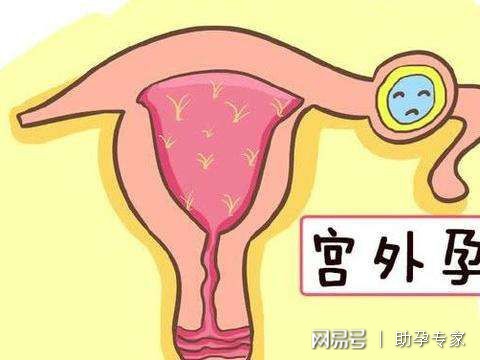 哪些情况需要检查输卵管？