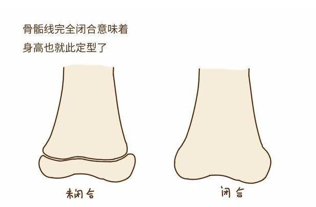 孩子的3个坏习惯，会使骨骺线提前闭合，家长要及早预防为好