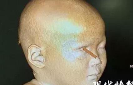 筷子戳进2岁女童眼睛，深入头颅！孩子有这个习惯一定要阻止