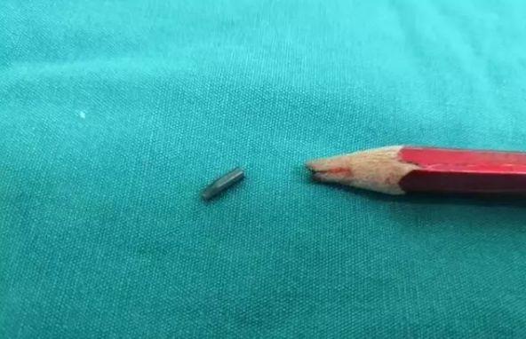 可怕！铅笔插进孩子后脑勺险没命！务必让孩子远离这些尖锐物