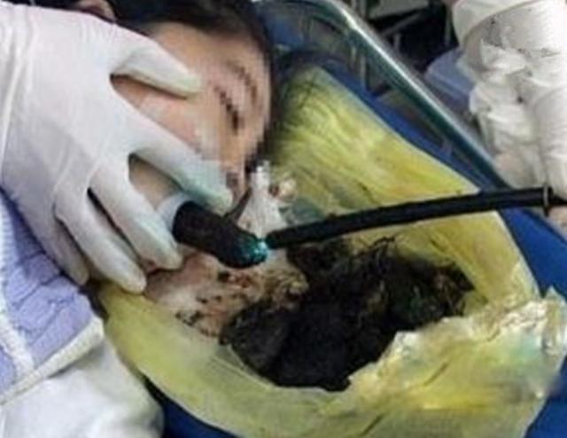八岁女孩吃头发五年多，她说“忍不住”，关于异食癖，一次讲清楚