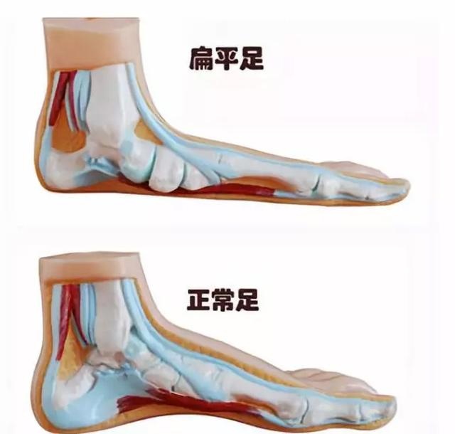 扁平足的危害大吗？来看看您的孩子是扁平足吗？