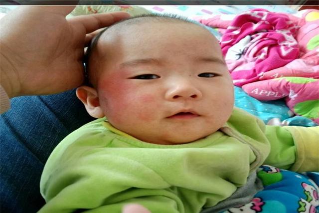 孩子起热痱子，被宝妈用上“土方法”，结果直接住院折腾7天？