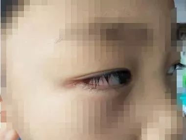 孩子上完游泳课后眼睛红肿、喉咙难受、想吐，游泳不当竟会得这种病