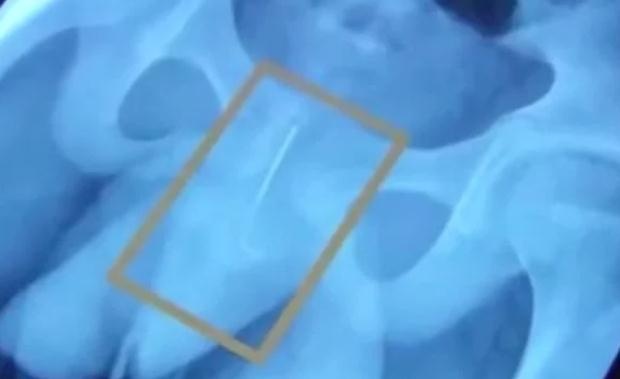 男孩写作业犯困，将长针插入尿道保持清醒，结果悲剧了