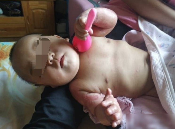 一个转身的瞬间，半岁幼儿掉入热水盆中，成了无法挽回的错