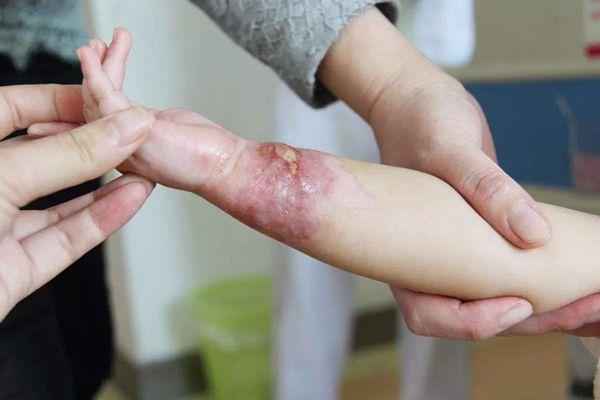 孩子被开水烫伤，妈妈第一时间的处理方法，连医生见了都夸赞