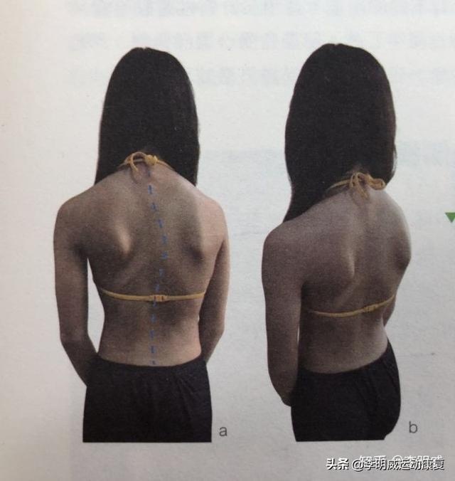 脊柱侧弯的认识与早期检查（孩子家长与老师必看）
