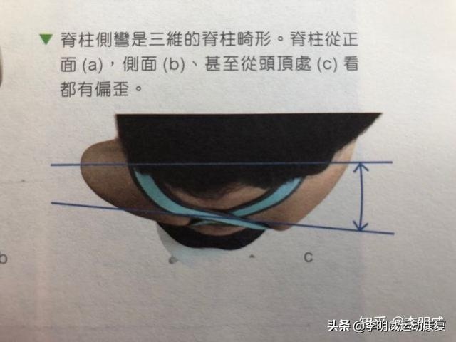 脊柱侧弯的认识与早期检查（孩子家长与老师必看）