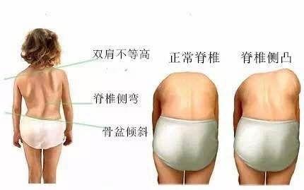 这个月龄前，要让孩子少站立！当心脊柱侧弯