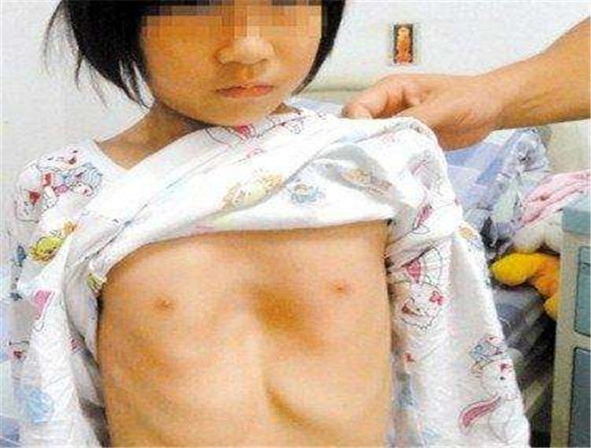 宝宝患“鸡胸”，罪魁祸首竟是父母忽略了这些小事！