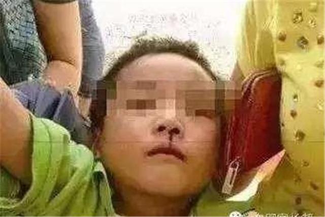 幼童流鼻血，被妈妈命令“仰头”，5分钟后却昏迷被紧急送医？