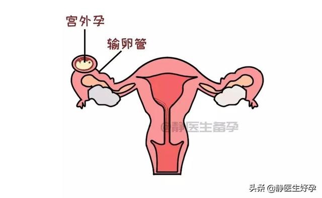 静医生备孕：宫外孕伤害那么大，想预防男人们也不能闲着