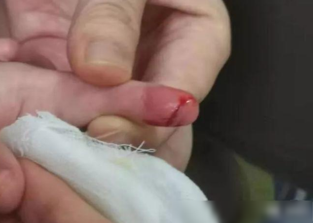 触目惊心！3岁男孩上了个厕所被缝了7针！很多家长都没留意过