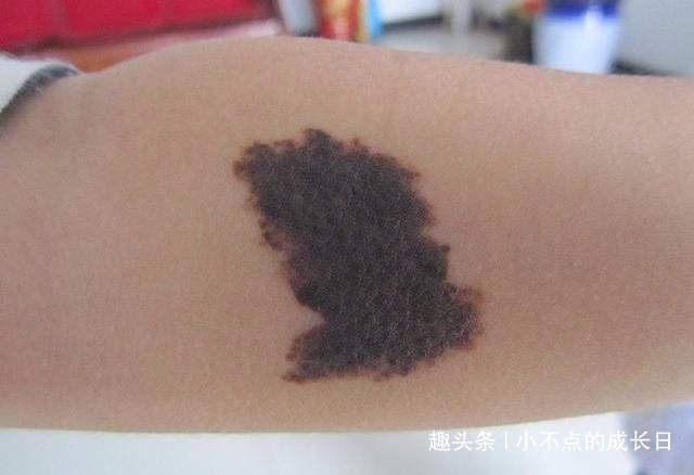 孕期这几种行为，容易让宝宝带胎记出生，孕妈妈要注意