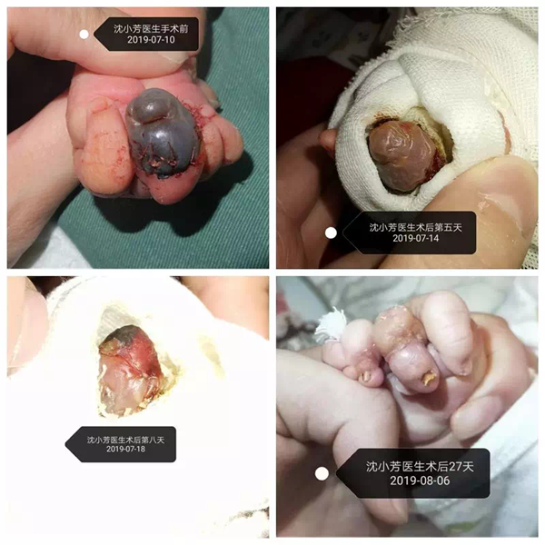 婴儿出生三天， 中指发紫长出一个“瘤” 很严重