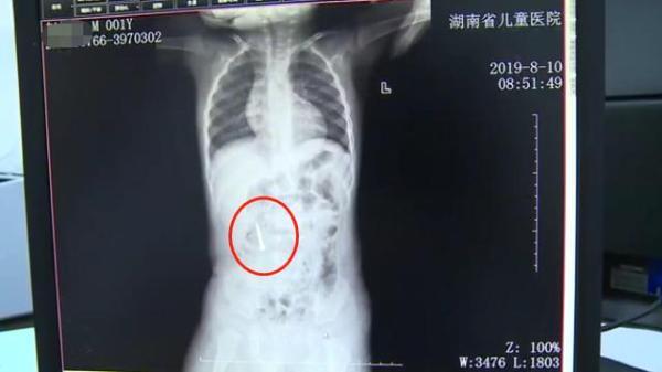 1岁男童误吞尖锐铁钉，医生：钉子的位置在不断变化，恐危及生命