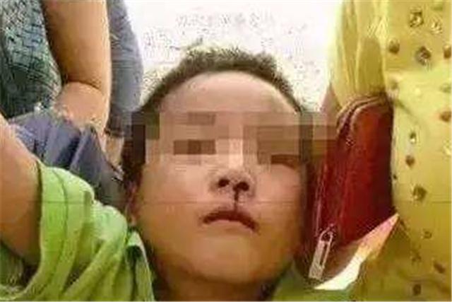 幼童“鼻血”不止，妈妈让其仰头静坐，10分钟孩子却倒地昏迷？