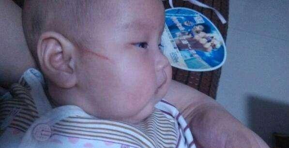 妈妈担心宝宝抓伤自己，买了“防抓脸手套”，却导致孩子手指截肢
