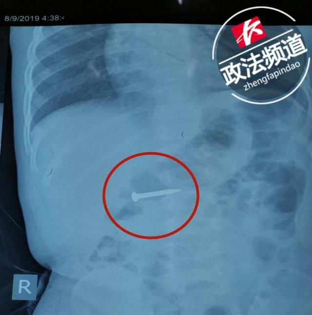 吓人！25mm长铁钉在1岁宝宝体内游走，医生紧急“截停”