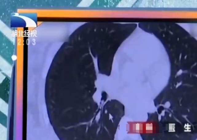 顽皮女儿误吞积木，母亲嘴对嘴吸出，不料把自己送进了医院