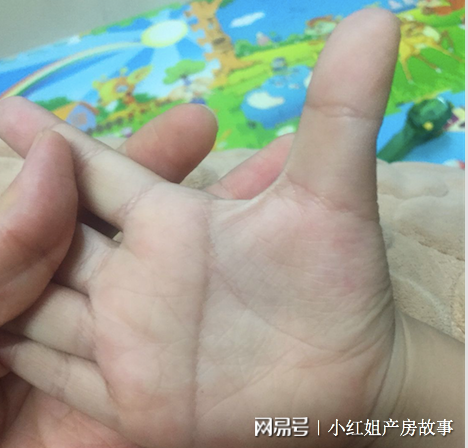 刚出生的婴儿手掌有贯通掌纹，怎么判断是不是唐氏儿？