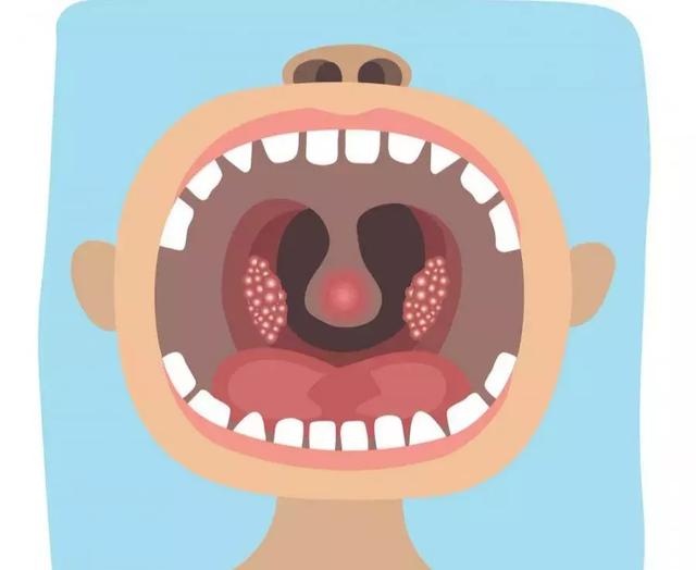高烧不退，嗓子、嘴唇、牙床都有小泡！幼儿园一个班接连中招