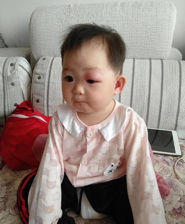 趁着夜深，蚊子“亲”了闺女一口，结果一觉醒来，妈妈笑开花