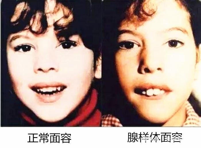 人长时间用嘴呼吸，相貌会变丑吗？科学已有答案
