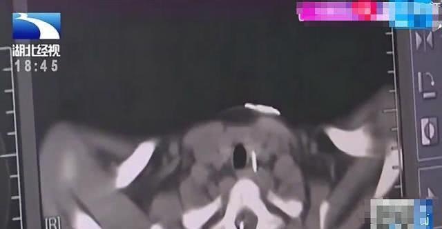 熊孩子模仿妈妈将钢针塞入肛门，7寸钢针危及生命，母亲：我在治便秘