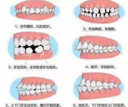 做牙齿矫正最佳年龄是多少岁？长大后还能矫正好吗？