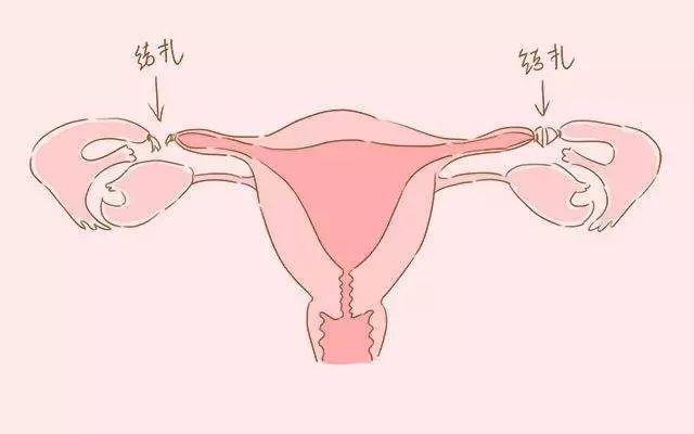 产后什么时候结扎好呢？#清风计划##健康早班车#